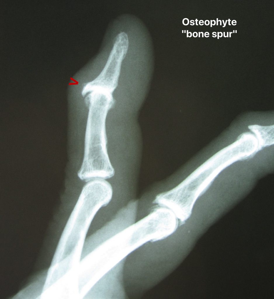 osteophytes x ray