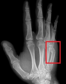 What is a Boxers Fracture? - Raleigh Hand to Shoulder Center | Raleigh ...