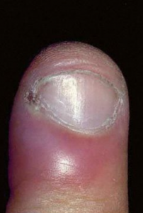 Understanding Paronychia: Fingernail Infection - Raleigh Hand to ...