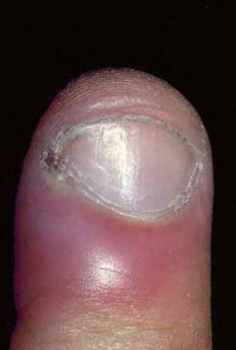 Of the many causes of swollen fingers, most are not serious